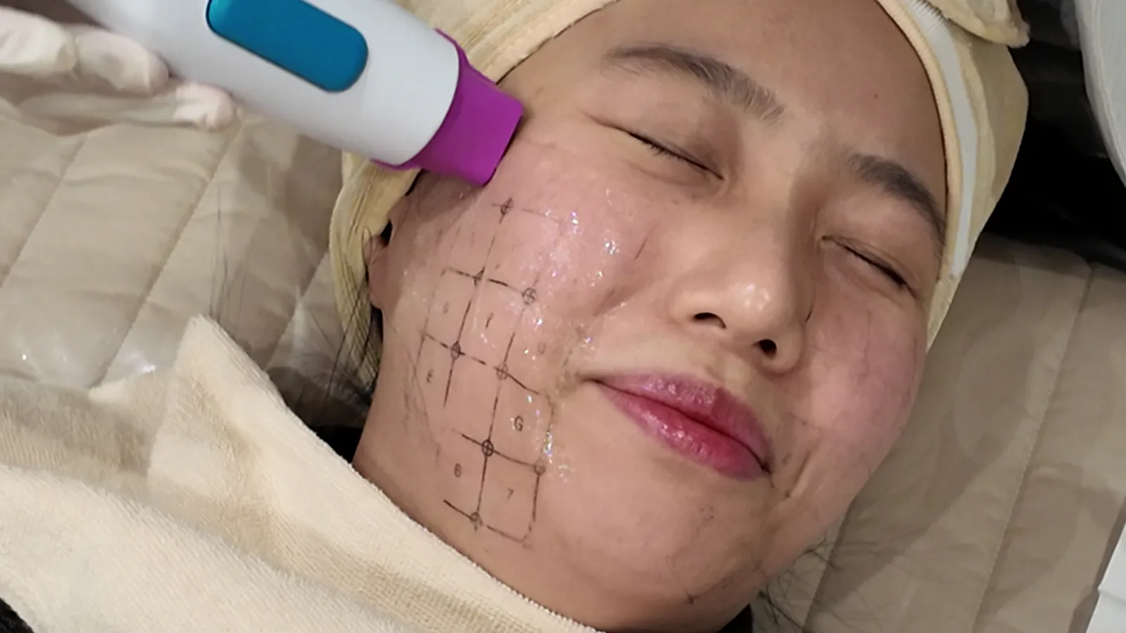 보라색 팁 핸드피스가 격자가 그려지고 젤이 발린 볼에 닿고 시술 침대에 누운 사람이 미소 짓는 모습